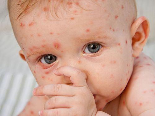 Tiêm phòng là cách tốt nhất để phòng tránh bệnh sởi ở trẻ em.