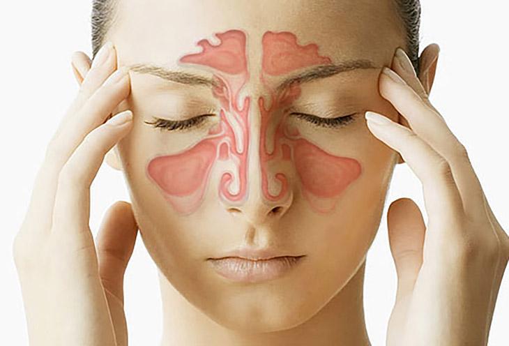 Viêm xoang sàng sau gây nên tình trạng đau nhức thái dương